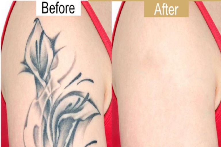 What to Expect After Each Tattoo Removal Session